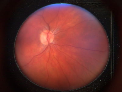 1st attempt with Volk Pictor
1st attempt with Volk Pictor.
Undilated. Pupil about 5mm
Autofocus.
comments invited
