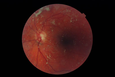 Two extremes of Asteroid Hyalosis just for reference!
