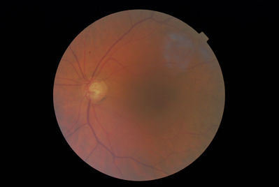 Glaucomatous Changes? 2012
