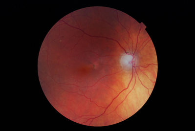 Glaucomatous Disc
Obviously glaucomatous disc. Has had Trabs in past, now on Lumigan and IOP's well controlled. 6/12 VA R&L but early AMD also! 
