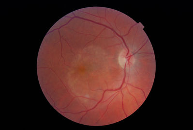 Undiagnosed Macular problem
48yrs F, VA 6/18+2, previous VA 6/5-3.
No diagnosis by ophthalmologist as yet, ongoing checks.
