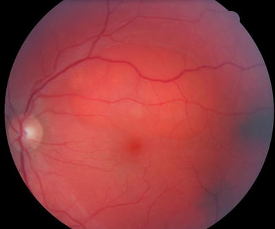 Central Serous Retinopathy
Middle aged man complaining of inferior field disturbance in his L eye.
Keywords: Central Serous retinopathy