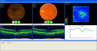 Improved Drusen
Patient who's been on Macushield for roughly 10 months ish.
