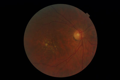 more disappearing drusen! 2011
http://theoptom.com/viewtopic.php?p=299480#299480
