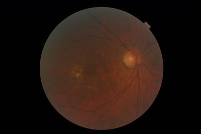 more disappearing drusen! 2012
http://theoptom.com/viewtopic.php?p=299480#299480
