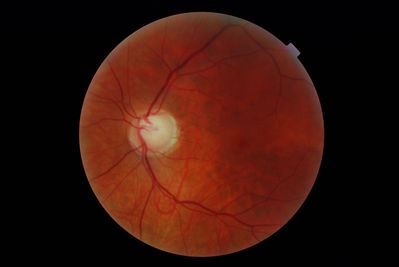 Thoughts on these ONHs
taken with Topcon NW6s, thread in clinical section
http://theoptom.com/viewtopic.php?p=256032#256032
