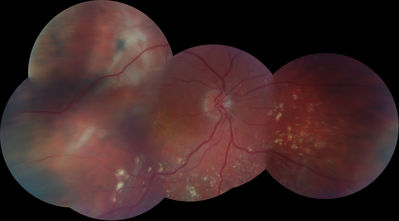 Macula off RD post surgery photo (see photo from 17/03/2012)
