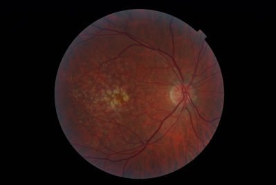 2011 - disappearing drusen http://theoptom.com/viewtopic.php?p=298608#298608
