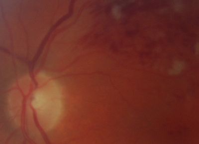 Close up of occluded vein
