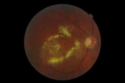 March 2011 - ?Retinal Artery Macroaneurysm
