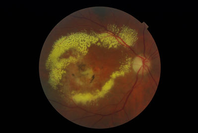 March 2012 - ?Retinal Artery Macroaneurysm
