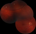 Retinoschisis.JPG