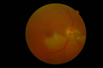 Branch Arteriole occlusion
Taken on a Topcon NW100. 3/7 history of shadow in superior field. History of stroke, recent disruption of medications.
Keywords: Vessel occlusion