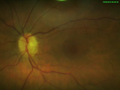 reflections on sup ret vein
,
