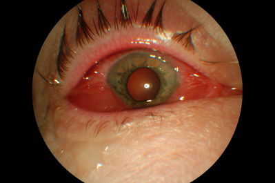 Conjunctival Chemosis acute bilateral presentation
kowa non-myd 7
