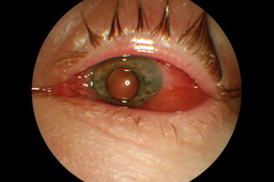 Conjunctival chemosis - acute bilateral presentation
Taken with Kowa non-myd 7
