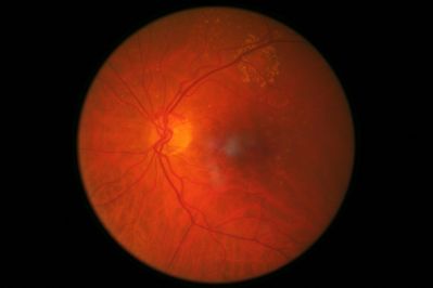LE Disc Haemorrhages & Colloid Bodies
Presented routinely, Photos 2008 no Haem, 2009 no HaemH; 2010 HaemH sup to disc, 2011, reduced. Blood tests by OMP nil of note, Cupping Inferior? I<S>N>T 0.4 IOPs 9 with NCT. VA 6/6-
Keywords: Disc Haemorrhage