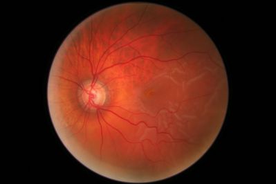 Retinal Detachment
C/o shadow coming across vision 6 days ago,. vision HM
