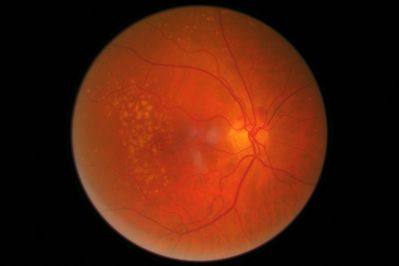 RE Disc Haemorrhages & Dry ARMD
Presented routinely, Photos 2008 no HaemH, 2009 HaemH worsening 2010, stable 2011. Blood tests by OMP nil of note. IOPS 10 with NCT. VA 6/5.
Keywords: Disc Haemorrhage