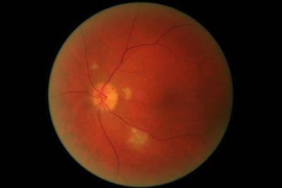 Cotton Wool Spots
70yr old male on chemo for Liver cancer, first sight test struggling to read (no previous glasses) Recently told also Diabetic. RE.
