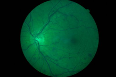 CRVO LE after 3 months
