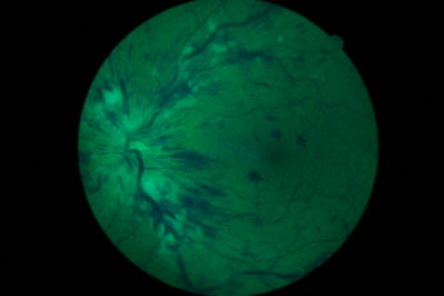 CRVO LE - non-ischaemic - on Presentation

