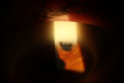 Tattoo
Pigment tattoo applied to cover up a YAG iridotomy causing diplopia
Keywords: YAG iridotomy Diplopia