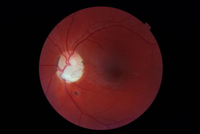 2 Discs Better Than One?
LE congenital disc anomoly. It looks like 2 discs but is actually a vessel travelling out of the Optic nerve before turning back in. Superior altitudinal hemionopic field defect. 

Taken with NW6S & D80 back.
