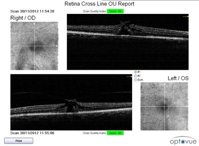 Bilateral simultaneous macular holes
