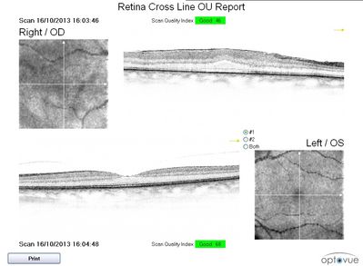RE Epi-retinal membrane
Px C/O a 'problem' with her RE for the past 2 months. V/A dropped from 6/6 to 6/24.
