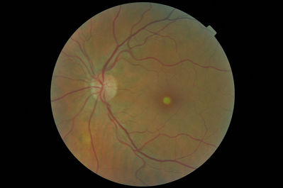 55 yr old female. 1st exam with us. Seen in HES and told congenital macular holes. These pics don't do them justice. They were perfect holes.
