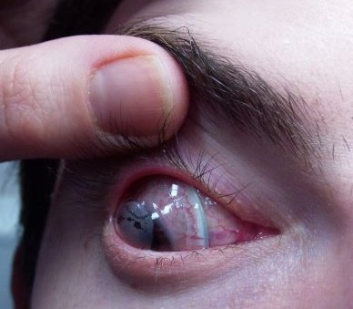 Scleral lens
My eye with a scleral lens in/on
Keywords: Scleral contact lens