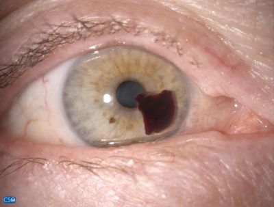 Iris tufts sequel, sudden loss of vision
