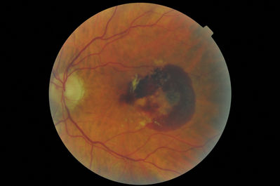 Conversion of dry AMD to wet AMD
The first photo is 2008. The second is 2012. This is a nice example with a clearly evident CNV membrane evident surrounded by haemorrhage. VA was reasonable at 6/24
Keywords: AMD