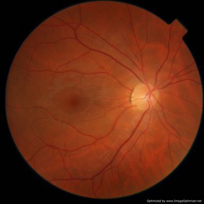 Crystalline Refractile deposits?
