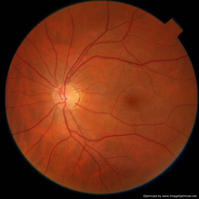 Crystalline Refractile deposits?
