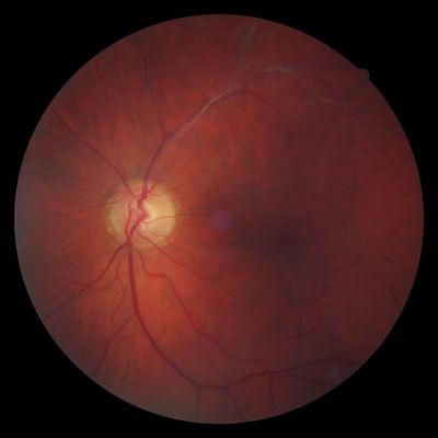 Thoughts welcome.....
65yr male c/o loss of vision in his RE 2 weeks ago - returned after a minute. On looking at the LE saw this unusual appearance in the superior fundus around the vessels. Opinions sought please......
