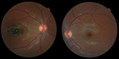 Diagnosed RE Toxoplasmosis in the past, but I'm not too sure
