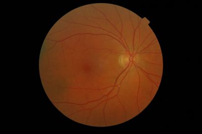 Hollonhurst Plaques . Pat subsequently diagnosed with Carotid Stenosis
