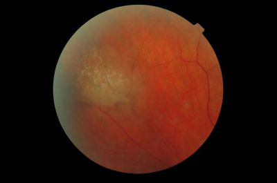 RD Left Supro nasal
Pre Laser tx 
