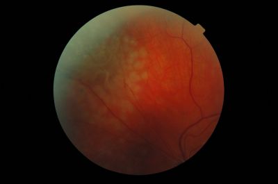 RD 1 Week post Laser
