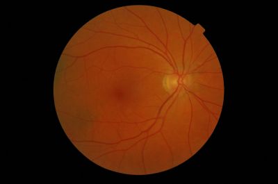 Previous Hollenhorst Plaques noted
See previous pic , this pic taken 2 years later , plaques are clear 
