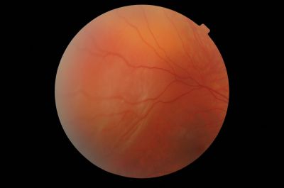 RE Temp-Suprotemp Detachment
Noted white lights when eyes closed about 3 weeks ago , noted a blur in the lower nasal field for the last week . 
