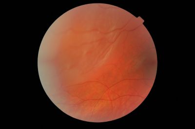 Suprotemp Detachment RE
Noted white lights when eyes closed about 3 weeks ago , noted a blur in the lower nasal field for the last week . 
