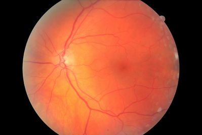 px cb central retina LE - pic 1
I tested this patient this week who reported a brilliant white flashing light in her LE over the past 2 months or so. VA =6/5 
