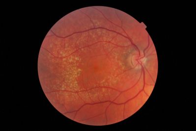 patient MR RE 2012
This is patient MR after being on icaps since 2008
