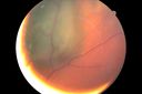 cb_sup_fundus_1.JPG