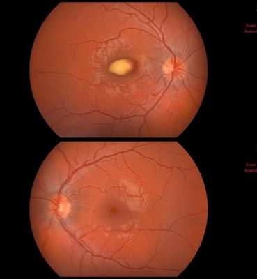 Yellow Macular Lesion
