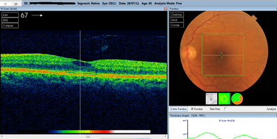 OCT scan
Can anyone help me identify what this is? Is it a resolving hole? Macular tear? Just fluid?
Keywords: Macula, hole, tear, OCT