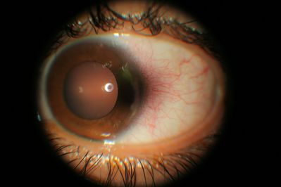 Anterior Eye Left
Temporal Degen?
